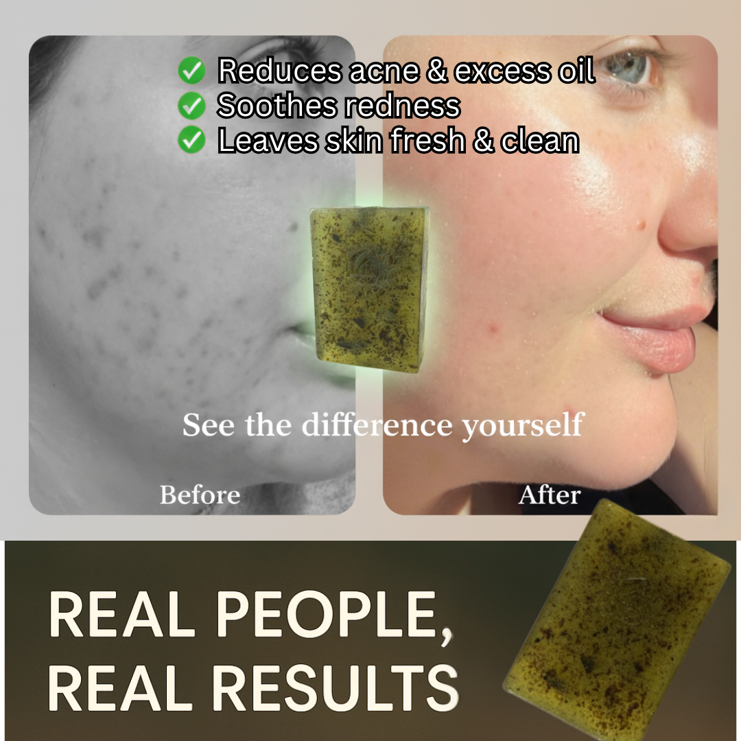 Anti-Acne Neem & Aloe Vera Soap